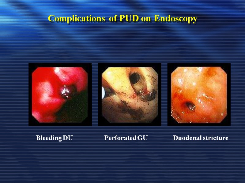 Complications of PUD on Endoscopy     Bleeding DU   Perforated